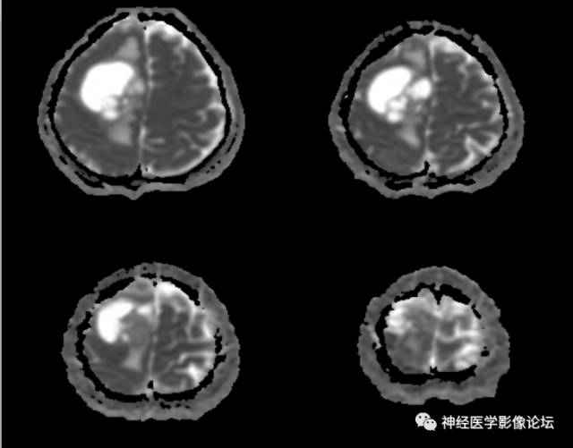 【病例】囊性(纤维型)脑膜瘤一例MR影像表现
