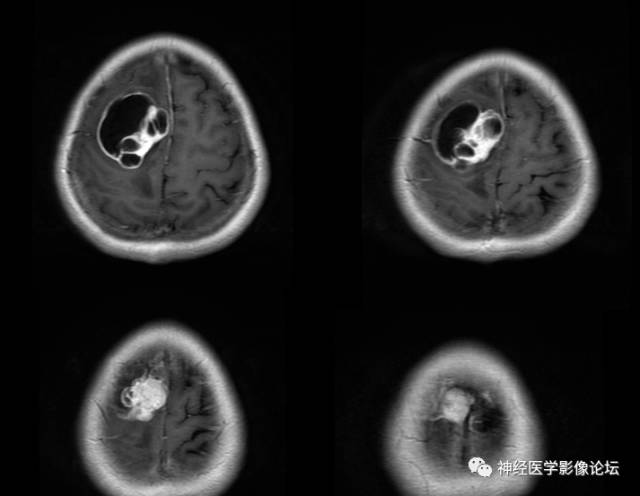 【病例】囊性(纤维型)脑膜瘤一例MR影像表现
