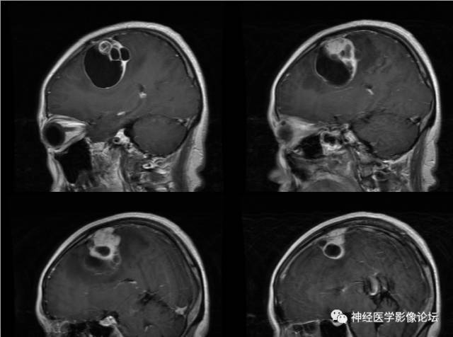 【病例】囊性(纤维型)脑膜瘤一例MR影像表现