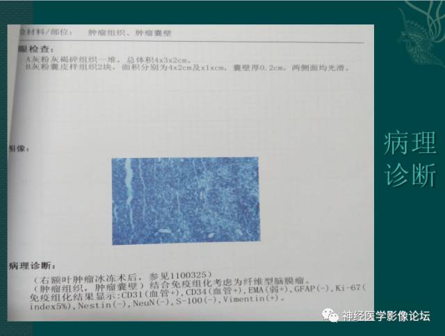 【病例】囊性(纤维型)脑膜瘤一例MR影像表现