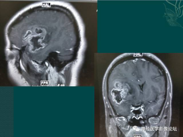 【病例】囊性(纤维型)脑膜瘤一例MR影像表现