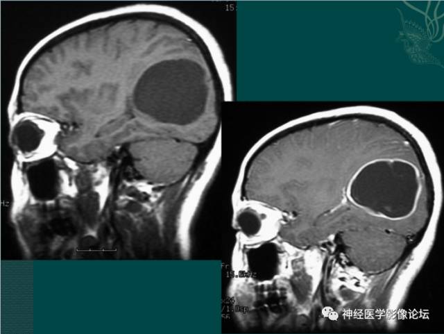 【病例】囊性(纤维型)脑膜瘤一例MR影像表现