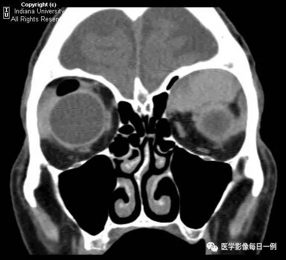 【病例】眼眶转移瘤1例CT及MR影像表现