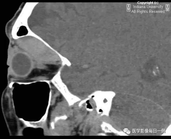 【病例】眼眶转移瘤1例CT及MR影像表现
