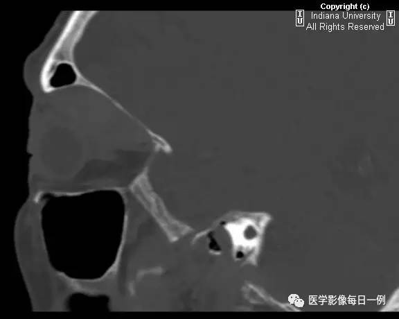 【病例】眼眶转移瘤1例CT及MR影像表现