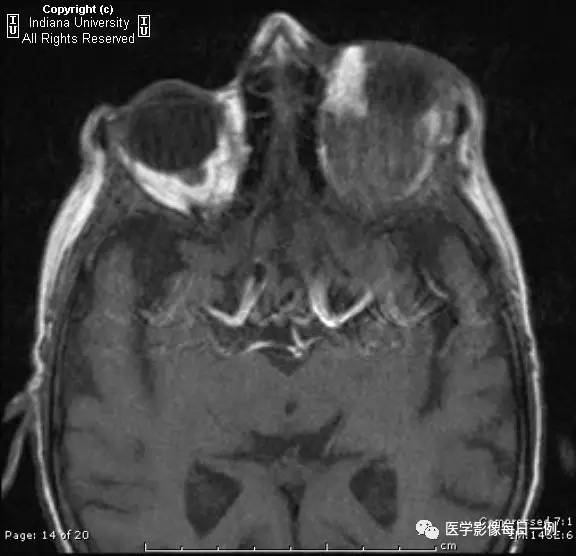 【病例】眼眶转移瘤1例CT及MR影像表现