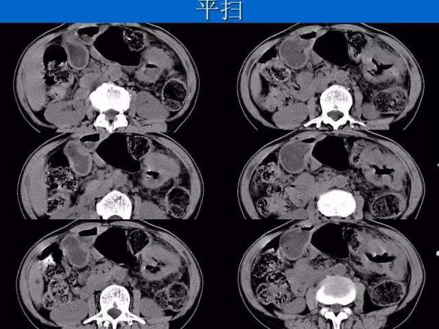 【病例】结肠高分化腺癌1例CT影像表现 【病例】结肠高分化腺癌1例CT影像表现
