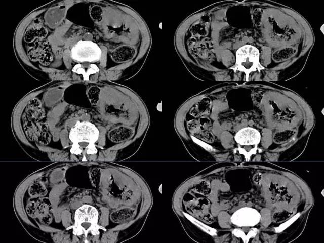 【病例】结肠高分化腺癌1例CT影像表现 【病例】结肠高分化腺癌1例CT影像表现