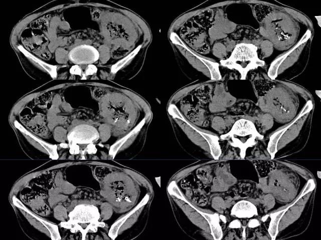 【病例】结肠高分化腺癌1例CT影像表现 【病例】结肠高分化腺癌1例CT影像表现
