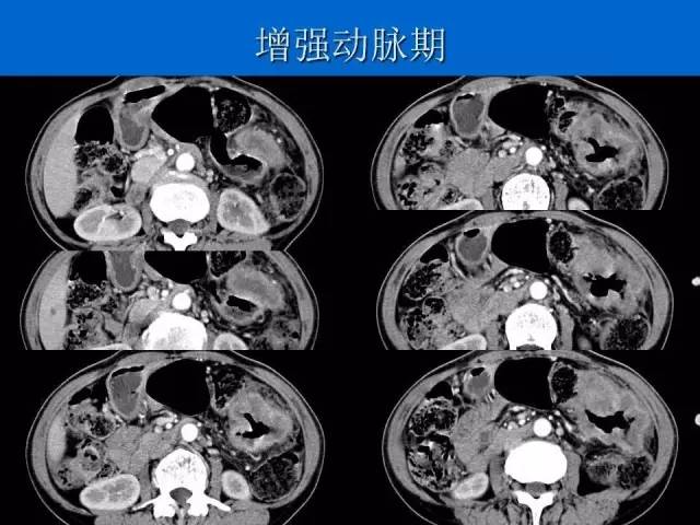 【病例】结肠高分化腺癌1例CT影像表现 【病例】结肠高分化腺癌1例CT影像表现
