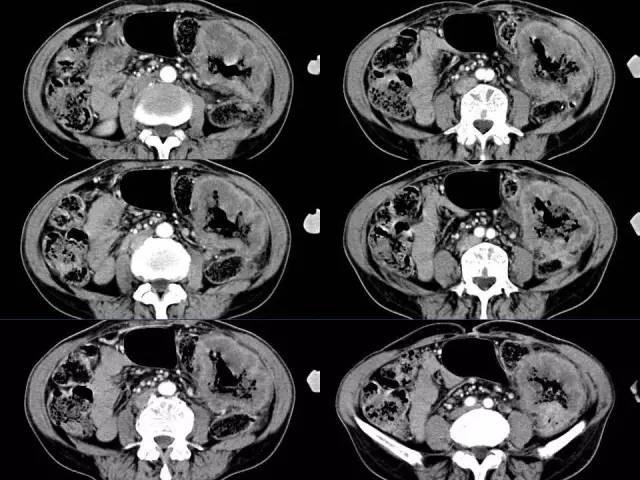 【病例】结肠高分化腺癌1例CT影像表现 【病例】结肠高分化腺癌1例CT影像表现