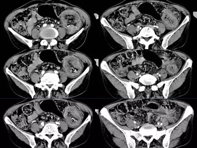 【病例】结肠高分化腺癌1例CT影像表现 【病例】结肠高分化腺癌1例CT影像表现