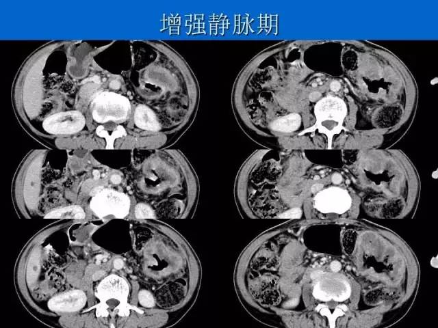 【病例】结肠高分化腺癌1例CT影像表现 【病例】结肠高分化腺癌1例CT影像表现