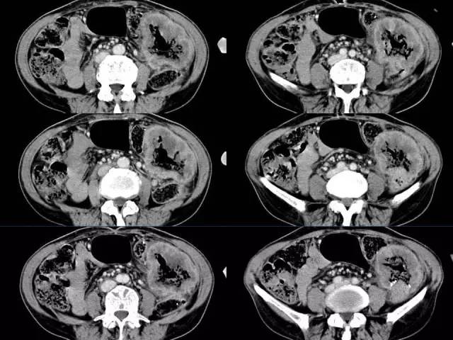 【病例】结肠高分化腺癌1例CT影像表现 【病例】结肠高分化腺癌1例CT影像表现