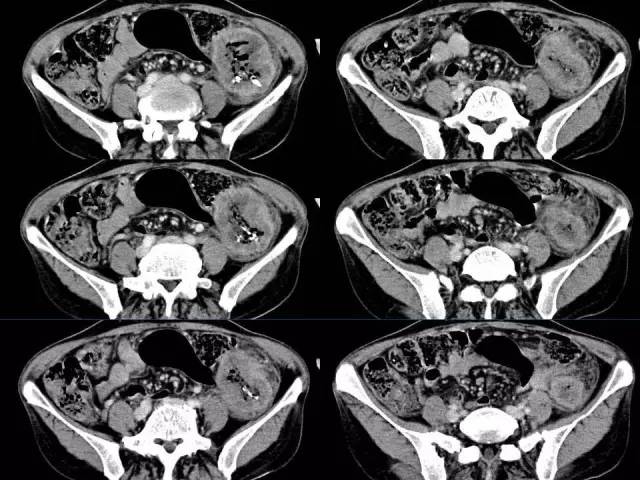 【病例】结肠高分化腺癌1例CT影像表现 【病例】结肠高分化腺癌1例CT影像表现