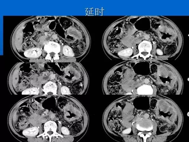 【病例】结肠高分化腺癌1例CT影像表现 【病例】结肠高分化腺癌1例CT影像表现