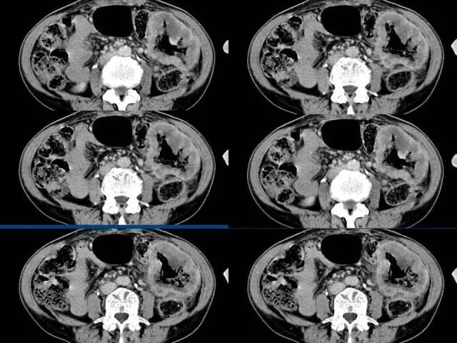 【病例】结肠高分化腺癌1例CT影像表现 【病例】结肠高分化腺癌1例CT影像表现