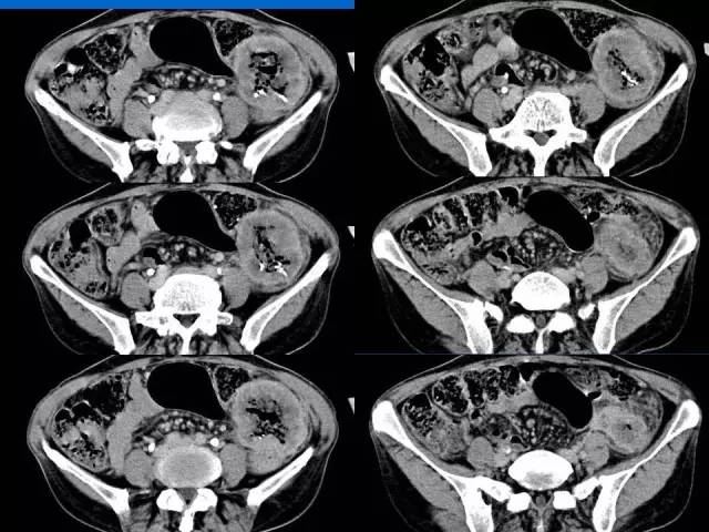 【病例】结肠高分化腺癌1例CT影像表现 【病例】结肠高分化腺癌1例CT影像表现