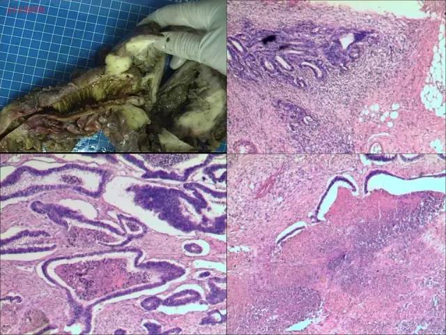 【病例】结肠高分化腺癌1例CT影像表现 【病例】结肠高分化腺癌1例CT影像表现