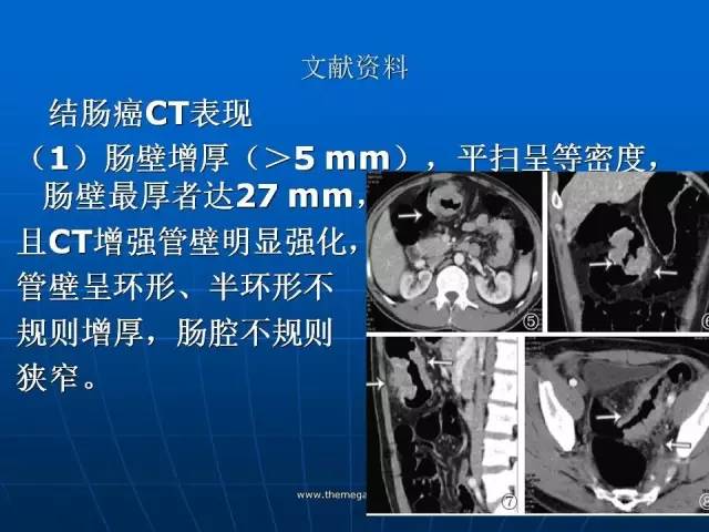 【病例】结肠高分化腺癌1例CT影像表现 【病例】结肠高分化腺癌1例CT影像表现