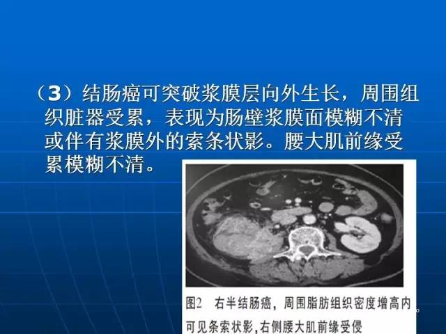 【病例】结肠高分化腺癌1例CT影像表现 【病例】结肠高分化腺癌1例CT影像表现