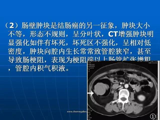 【病例】结肠高分化腺癌1例CT影像表现 【病例】结肠高分化腺癌1例CT影像表现