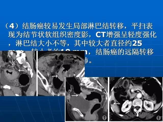 【病例】结肠高分化腺癌1例CT影像表现 【病例】结肠高分化腺癌1例CT影像表现
