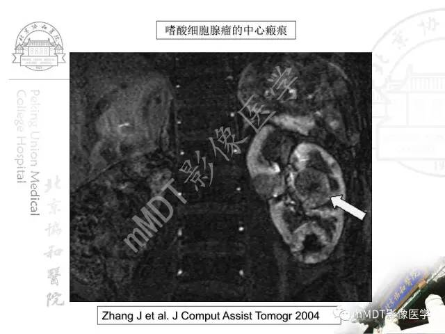 【PPT】肾实质常见肿瘤性病变的影像学诊断