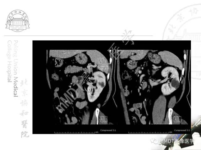 【PPT】肾实质常见肿瘤性病变的影像学诊断
