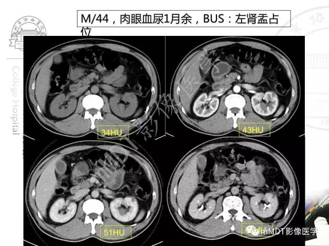 【PPT】肾实质常见肿瘤性病变的影像学诊断
