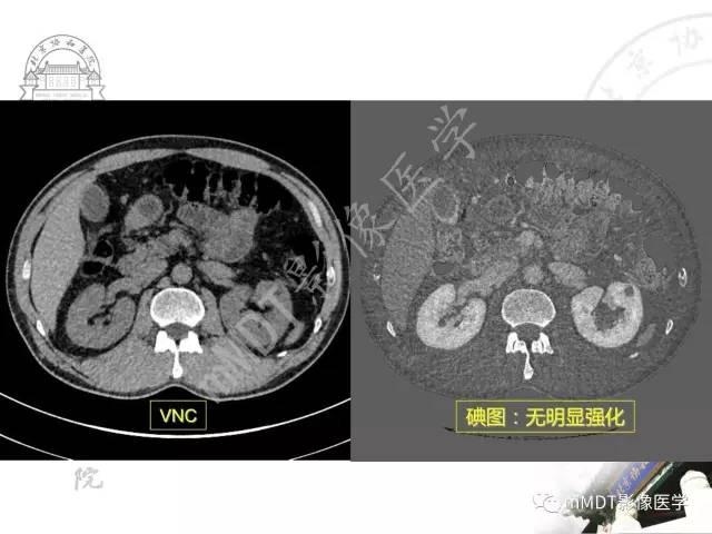 【PPT】肾实质常见肿瘤性病变的影像学诊断