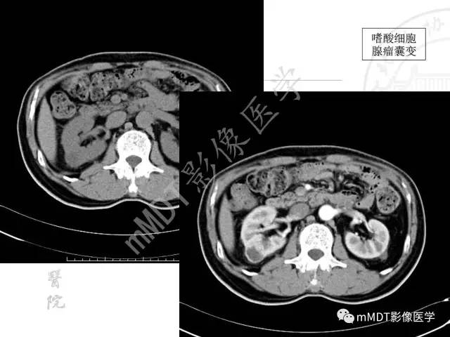 【PPT】肾实质常见肿瘤性病变的影像学诊断