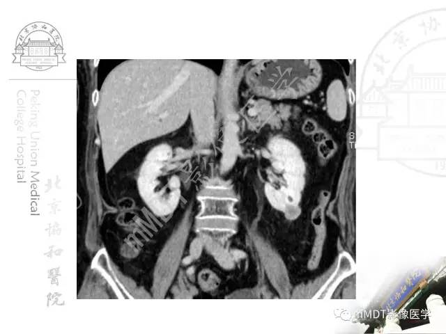 【PPT】肾实质常见肿瘤性病变的影像学诊断