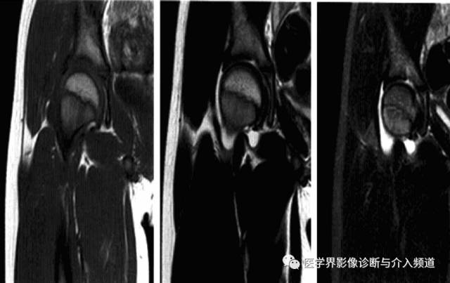 12种髋关节病变的影像鉴别诊断 12种髋关节病变的影像鉴别诊断