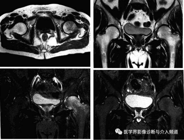 12种髋关节病变的影像鉴别诊断