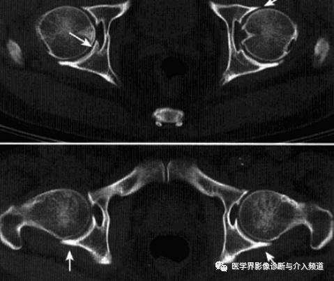 12种髋关节病变的影像鉴别诊断 12种髋关节病变的影像鉴别诊断