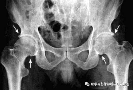 12种髋关节病变的影像鉴别诊断 12种髋关节病变的影像鉴别诊断