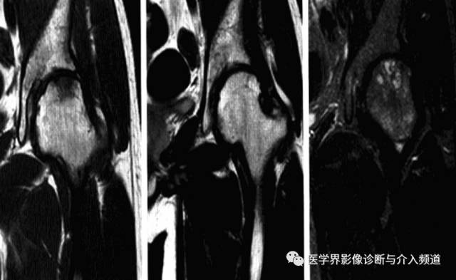 12种髋关节病变的影像鉴别诊断 12种髋关节病变的影像鉴别诊断