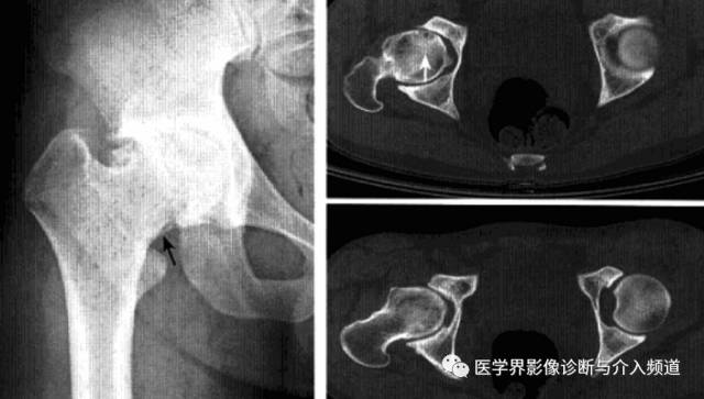 12种髋关节病变的影像鉴别诊断 12种髋关节病变的影像鉴别诊断