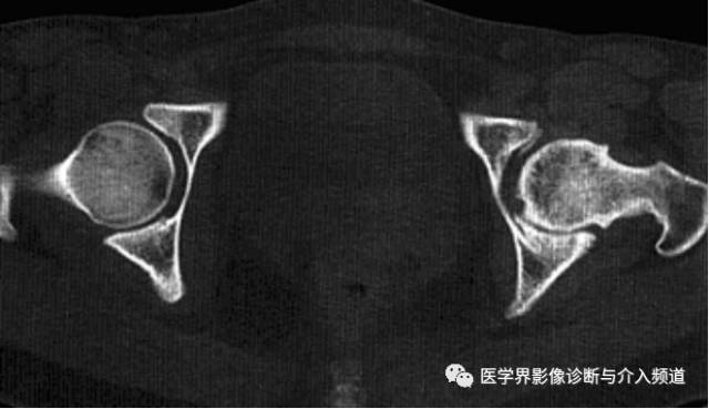 12种髋关节病变的影像鉴别诊断 12种髋关节病变的影像鉴别诊断