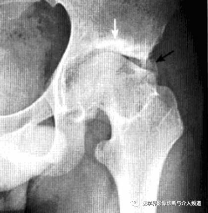12种髋关节病变的影像鉴别诊断 12种髋关节病变的影像鉴别诊断