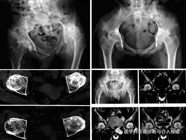 12种髋关节病变的影像鉴别诊断 12种髋关节病变的影像鉴别诊断