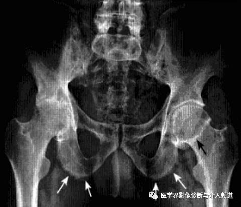 12种髋关节病变的影像鉴别诊断 12种髋关节病变的影像鉴别诊断