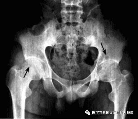 12种髋关节病变的影像鉴别诊断 12种髋关节病变的影像鉴别诊断