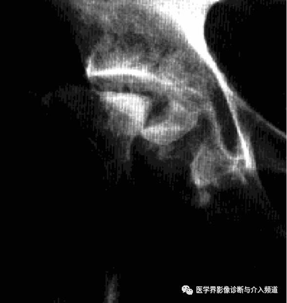 12种髋关节病变的影像鉴别诊断 12种髋关节病变的影像鉴别诊断