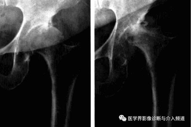 12种髋关节病变的影像鉴别诊断 12种髋关节病变的影像鉴别诊断