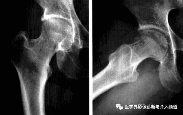 12种髋关节病变的影像鉴别诊断 12种髋关节病变的影像鉴别诊断