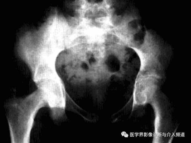 12种髋关节病变的影像鉴别诊断 12种髋关节病变的影像鉴别诊断