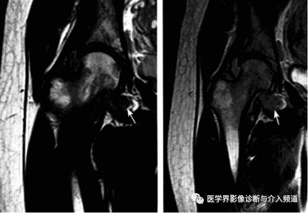 12种髋关节病变的影像鉴别诊断 12种髋关节病变的影像鉴别诊断