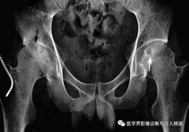 12种髋关节病变的影像鉴别诊断 12种髋关节病变的影像鉴别诊断